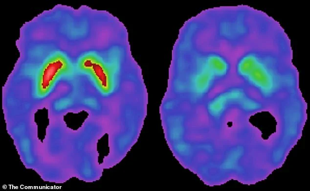 Human Pegavirus Linked to Parkinson’s Disease in New Study