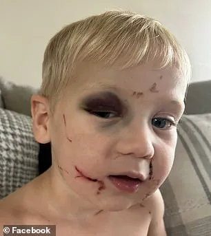 Daycare Worker Accused of Assaulting 1-Year-Old, Leaving Child with Black Eye, Facial Scratches, and Neck Wounds