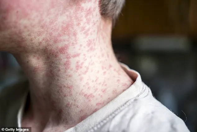 Utah Measles Outbreak Linked to Cycling Event Sparks Health Warnings