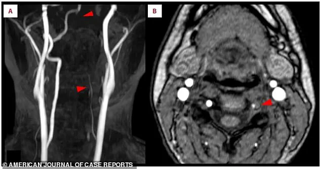 Urgent Warning: Stroke Linked to Nintendo Ring Fit Adventure Workout