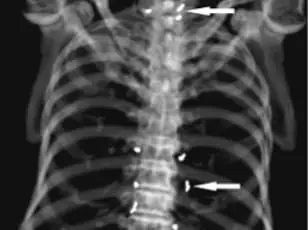 Medical Dilemma: Gold Threads from Acupuncture Treatment Raise Safety Questions in South Korea