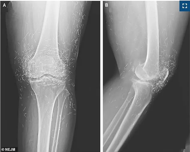 Medical Dilemma: Gold Threads from Acupuncture Treatment Raise Safety Questions in South Korea