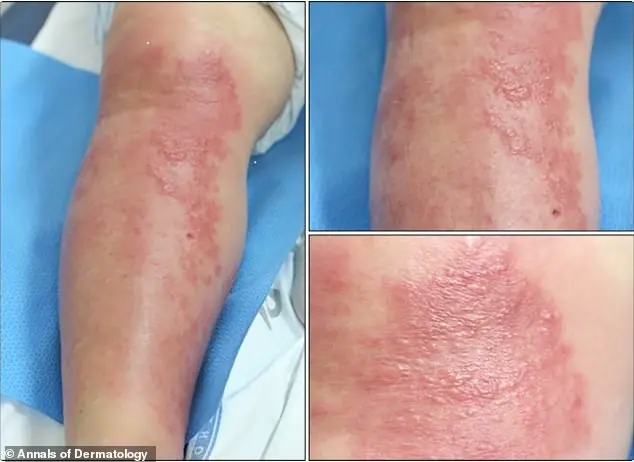 Medical Dilemma: Gold Threads from Acupuncture Treatment Raise Safety Questions in South Korea