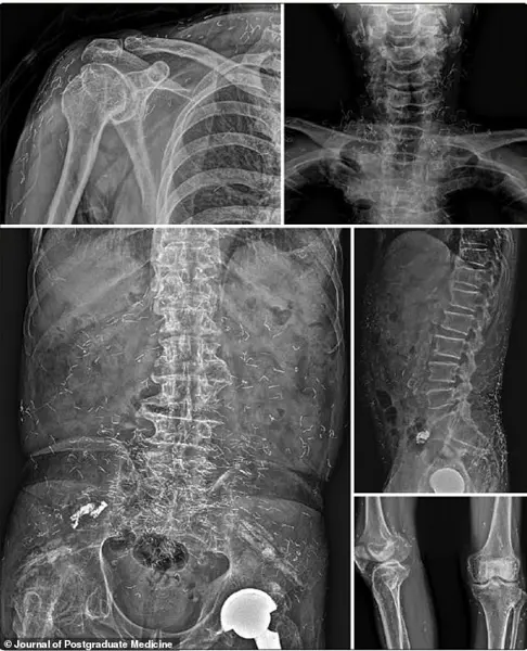 Medical Dilemma: Gold Threads from Acupuncture Treatment Raise Safety Questions in South Korea