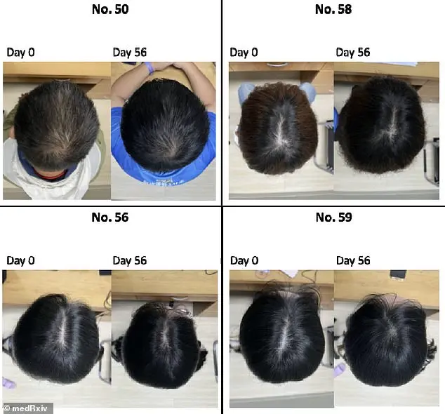 Taiwanese Scientists Develop Scalp Serum Using Centella Asiatica to Combat Hair Loss