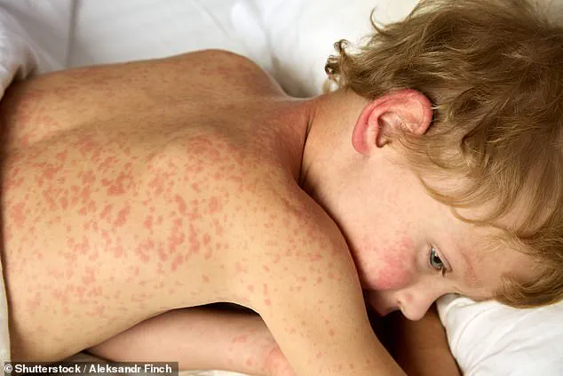 US Measles Outbreak Surpasses 2,000 Cases for First Time Since 1992, Three Fatalities Reported