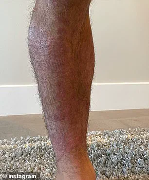 Chad Mendes' Journey to Health: How the Carnivore Diet Transformed His Life and Battle with Psoriasis