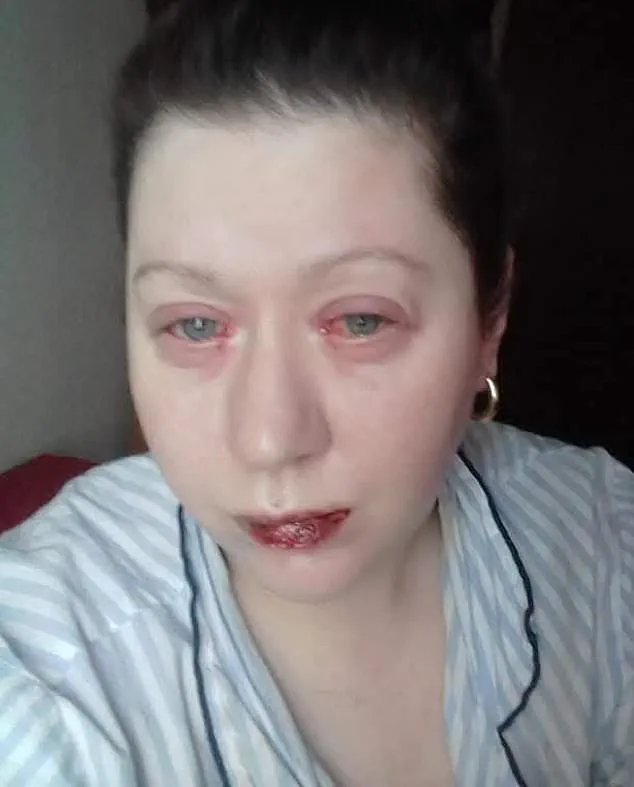 Urgent Warning: Benylin Linked to Permanent Health Effects After Routine Use – Late-Breaking Update