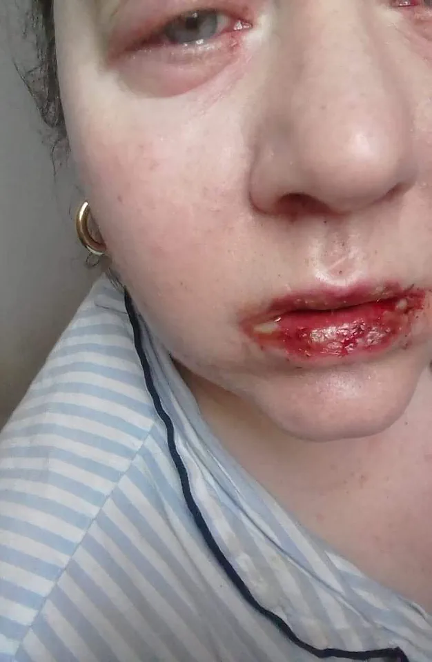 Urgent Warning: Benylin Linked to Permanent Health Effects After Routine Use – Late-Breaking Update