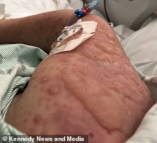 A 1-in-2,500 Chance: The Rare Reaction That Left Emily McAllister Blind and Scarred