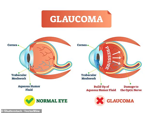 UK Glaucoma Crisis: Over a Million Living with Irreversible Blindness, Warns Institute of Ophthalmology Report