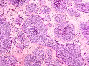 Experimental Vaccine Offers Hope for Triple-Negative Breast Cancer Survivor