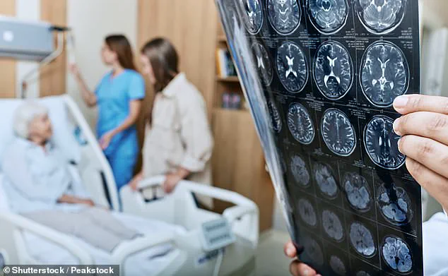 Gut Microbiome's Role in Alzheimer's: Groundbreaking Study Reveals Causal Link