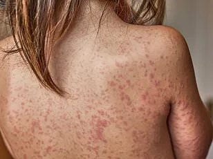 Measles Outbreak Linked to DC March for Life Rally Sparks Public Health Concern