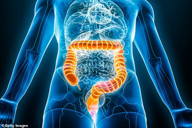 Bowel Cancer Surge in Young Brits: Why the UK Diverges from Europe