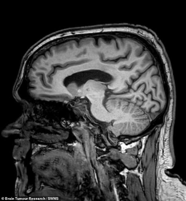 When Fatigue Signals a Brain Tumor: The Urgent Need for Awareness