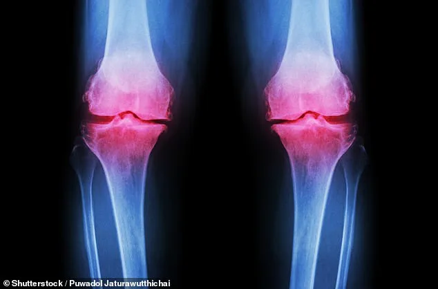 Alarming Rise in Younger Patients' Osteoarthritis Tied to Extreme Fitness and 'Clean Eating' Diets, Experts Warn