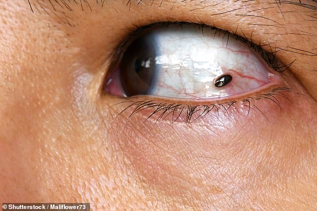 A Subtle Freckle and Sudden Symptoms: The Eye Exam That Changed Everything