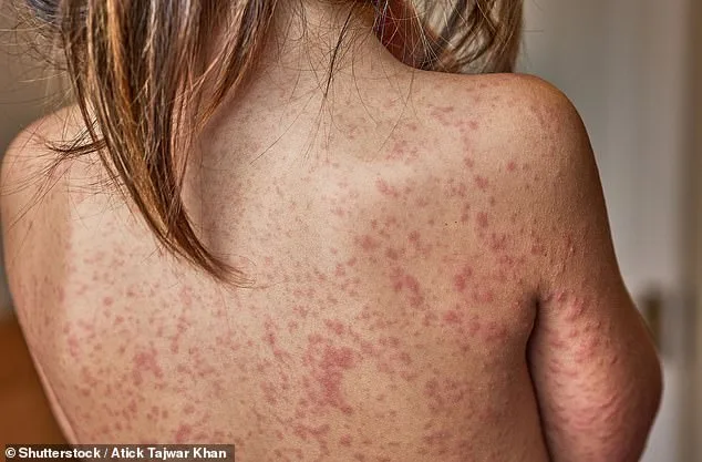 Measles Outbreak Alarms London as Unvaccinated Children Fuel Surge in Cases, UK Reports Worst Outbreak in 2024