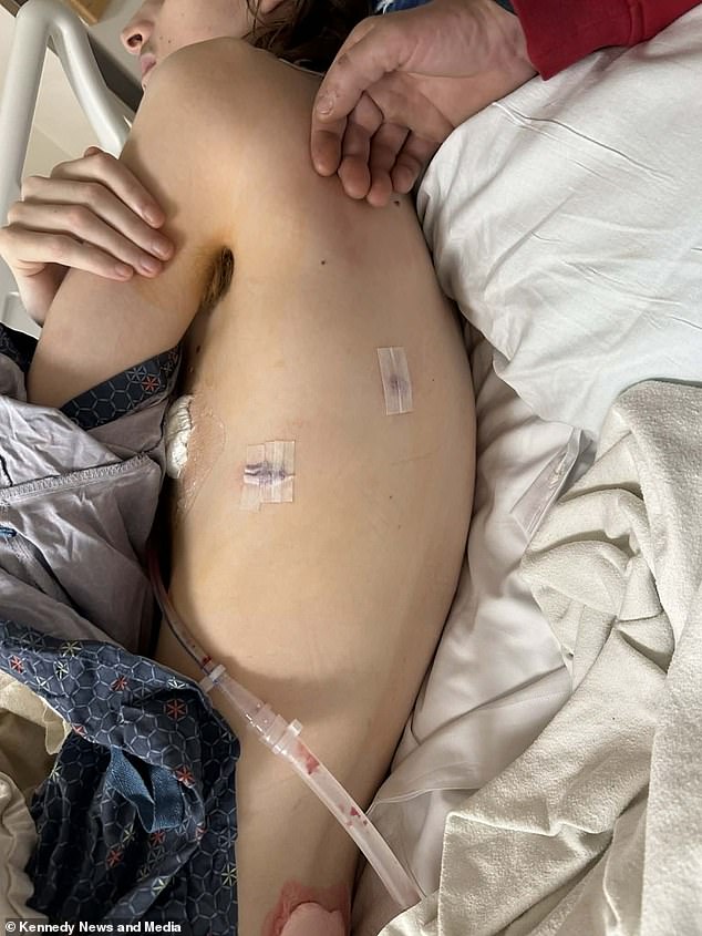 Vaping's Hidden Danger: A Teen's Journey to Recovery from a Collapsed Lung