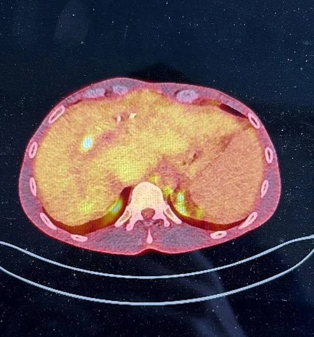 NHS Denies Life-Saving Liver Transplant to James Conradi Over 4mm Tumor Size Threshold