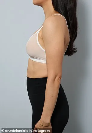 From Big to Balanced: The 'Ballerina Breast' Trend Redefines Modern Beauty Standards