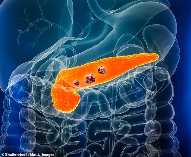Pancreatic Cancer Breakthrough: Early Warning Signal Found Years Before Symptoms