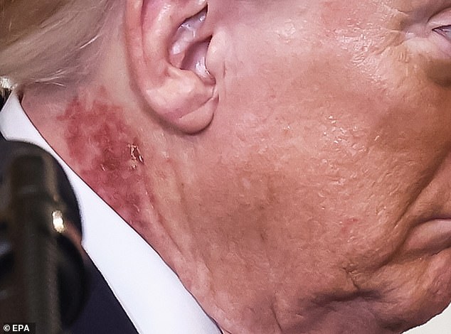 Trump's Mysterious Rash Sparks Health Speculation Despite Doctor's Statement