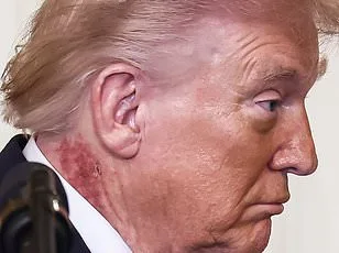 Trump's Mysterious Rash Sparks Health Speculation Despite Doctor's Statement