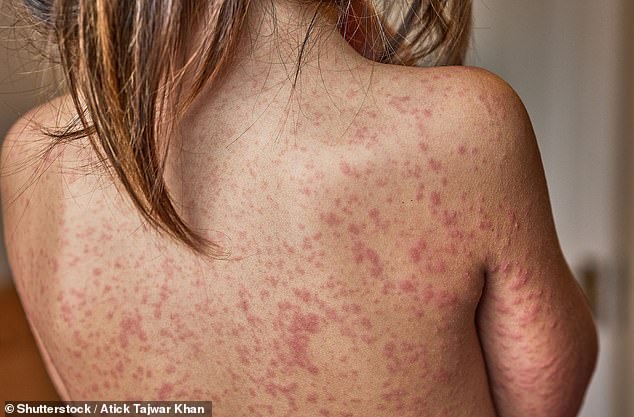 London Considers Excluding Unvaccinated Kids from Schools as Measles Cases Surge