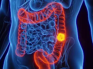 Dental Signs May Signal Bowel Cancer Risk: Oral Microbiome Link Revealed in UK Study