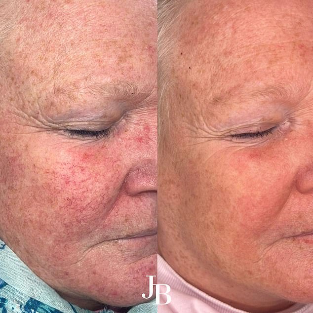 Breakthrough Laser Therapy BBL HEROic Offers New Hope for Millions with Rosacea