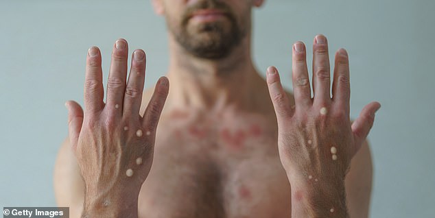 New York City Reports First Local Case of Deadlier Clade I Mpox; 12th U.S. Case Since November 2024