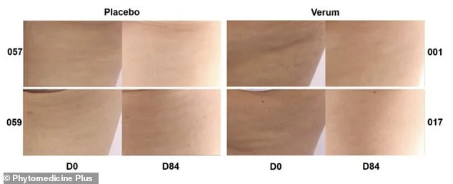 French Maritime Pine Bark Extract May Revolutionize Cellulite Treatment with Promising Clinical Results