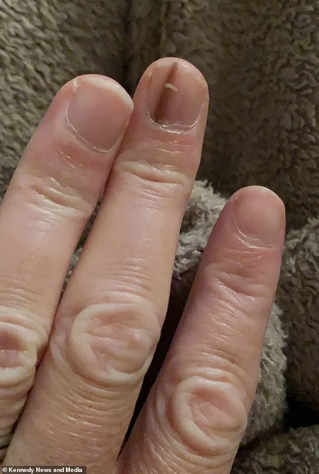 A Faint Brown Line: The Hidden Warning Sign of Aggressive Melanoma That Led to Amputation