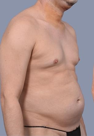 Frank Hoyle's $23,000 Liposuction Miracle: From Stubborn Fat to 20s-Like Abs