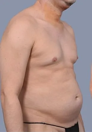 Frank Hoyle's $23,000 Liposuction Miracle: From Stubborn Fat to 20s-Like Abs