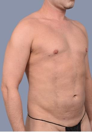 Frank Hoyle's $23,000 Liposuction Miracle: From Stubborn Fat to 20s-Like Abs