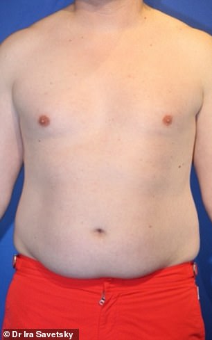 Frank Hoyle's $23,000 Liposuction Miracle: From Stubborn Fat to 20s-Like Abs