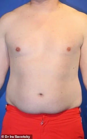 Frank Hoyle's $23,000 Liposuction Miracle: From Stubborn Fat to 20s-Like Abs