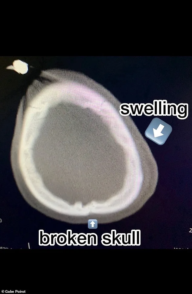 Miraculous Survival After Electric Skateboard Crash Leaves Man With 99% Brain Stem Damage