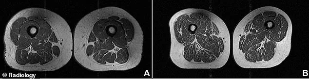 New images reveal ultra-processed foods turning human muscle into marbled fat.