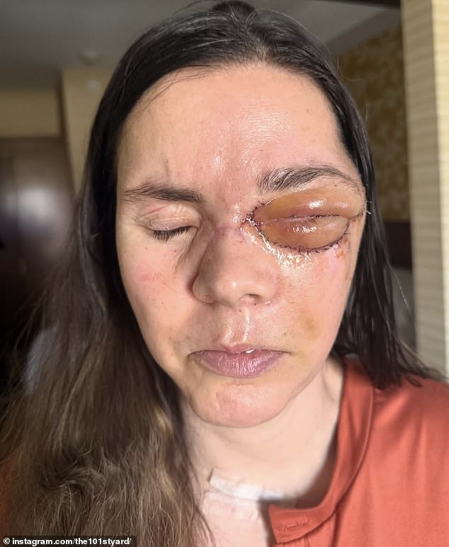 Alaska woman survives brutal grizzly bear attack that caused permanent brain damage