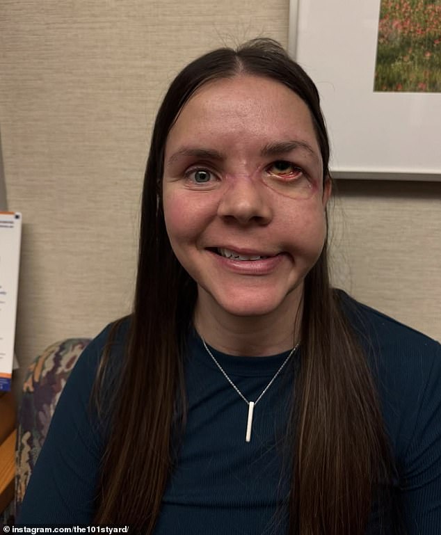 Alaska woman survives brutal grizzly bear attack that caused permanent brain damage