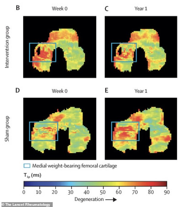 Stanford Study Shows Walking Angle Changes Can Reduce Knee Arthritis Pain