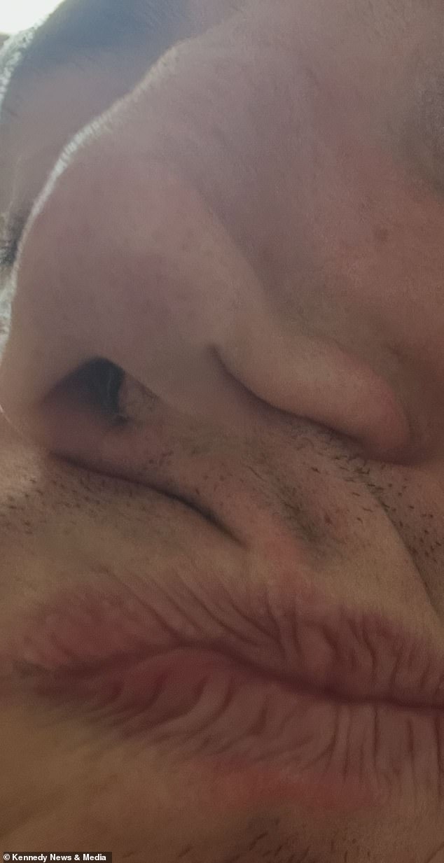 Bradley Robinson reveals permanent facial disfigurement after 15 years of cocaine addiction.