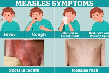 Health Officials Sound Alert Over Measles Case in Washington D.C.