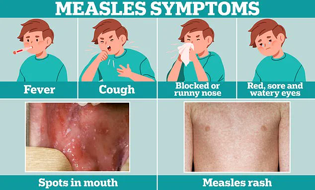 Health Officials Sound Alert Over Measles Case in Washington D.C.