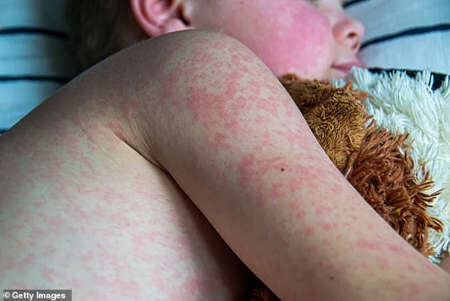 Houston Reports New Measles Case in Infant; Urgent Call for Vaccination Amid Regional Outbreaks