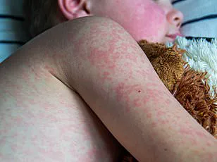 Measles Breakthrough Case Highlights Vulnerability of Partially Vaccinated Populations